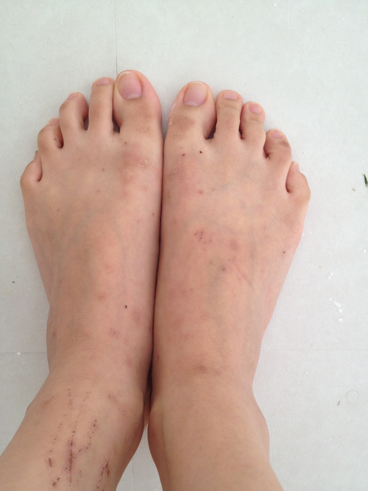 My scabies nightmare experience...do not open if sensitive to pictures with rashes/spots. How to